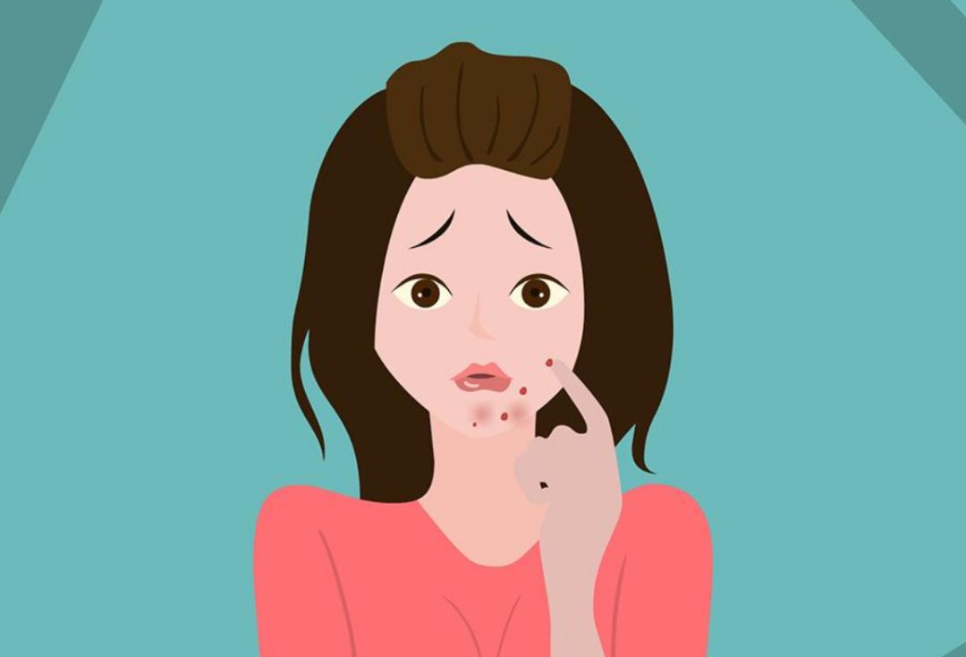 痘痘肌下巴长痘怎么处理,下巴长痘怎么正确护肤