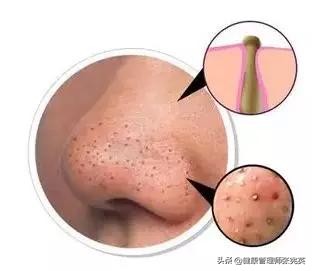 身体长小米粒是什么原因,背后长了很多小米粒