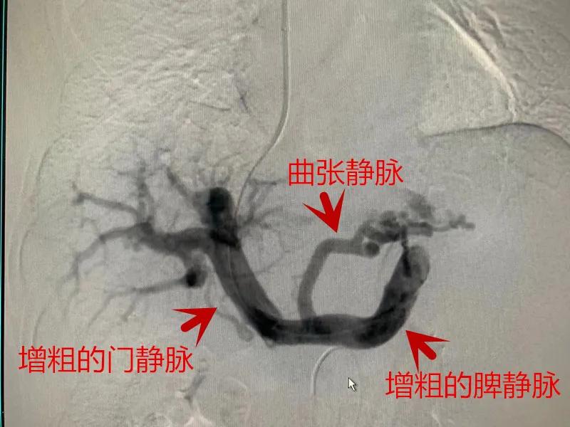 肝硬化门脉高压物理治疗方法,肝硬化失代偿期门脉高压