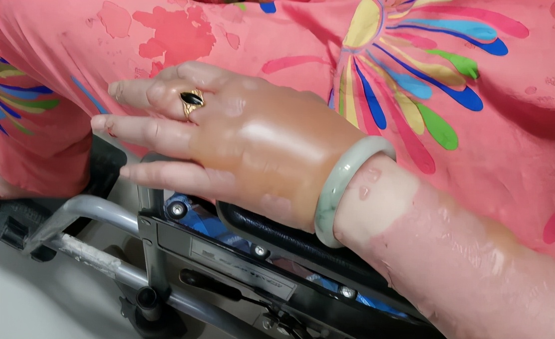 气球爆燃致女子烧伤,女子喷洒杀虫剂爆炸