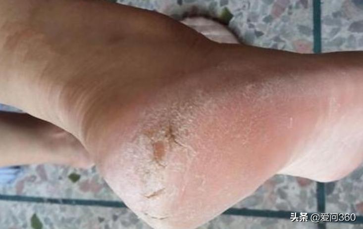 中老年人脚后跟开裂，大多是这些原因造成的，5个方法可改善