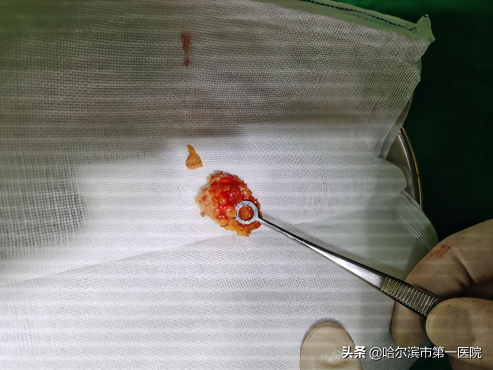 乳腺癌前哨淋巴结活检辅助手术,哈尔滨肿瘤医院做乳腺手术