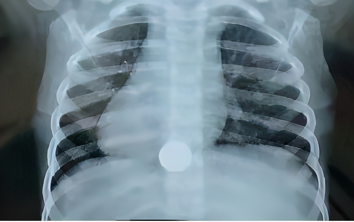 孩子误吞硬币怎么办,孩子误吞硬币怎么解决