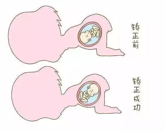 一般胎位不正是什么原因引起的,什么样的原因会导致胎位不正