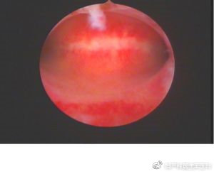 输卵管造影通而不畅怎么治疗,输卵管通而不畅医生如何诊断