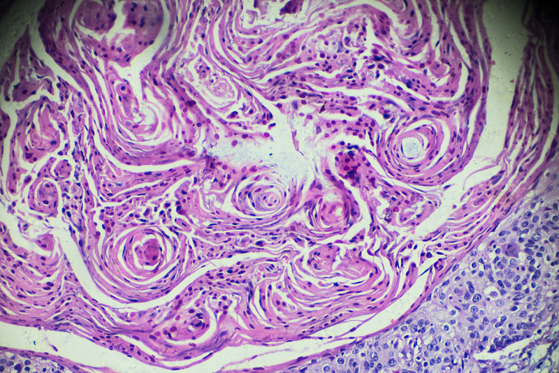 感染hpv怎么样快速转阴,感染了hpv病毒要怎么才能转阴