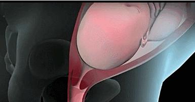 枕后位更痛吗,枕后位容易顺转剖吗