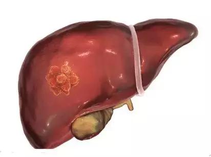 发现肝部有小结节用治疗吗,发现肝脏结节要做哪些检查