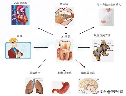 牙周病不能治好的吗,牙周病不治疗后果