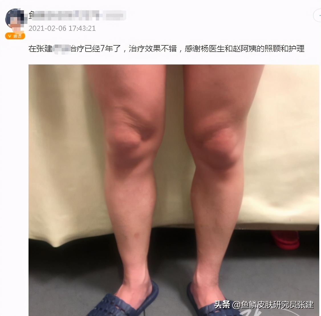 90岁老中医治鱼鳞病,中医实战笔记鱼鳞病