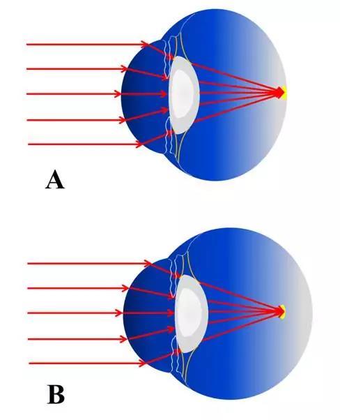 近视是怎样形成的实验过程,近视是怎样形成的原因