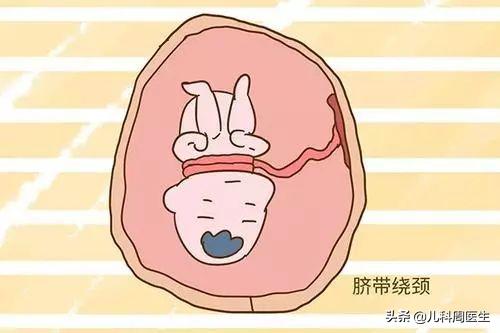 胎儿脐绕颈一周会自己绕回来吗,胎儿绕脐带3圈怎么办