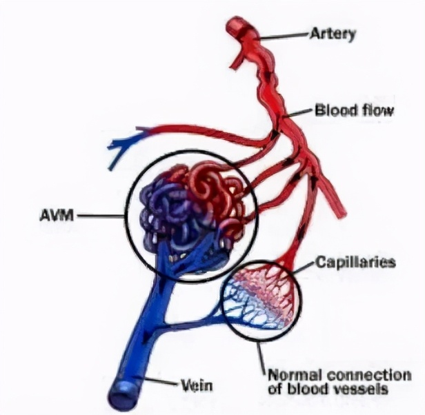 儿童脑血管畸形保守治疗方法,脑血管畸形加动脉瘤保守治疗