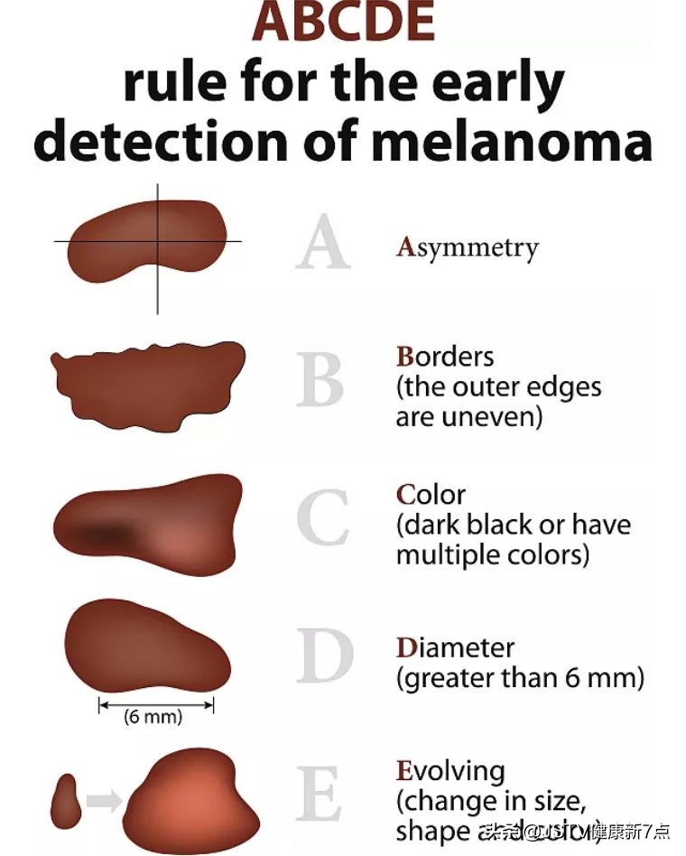 普通的痣会变成黑色素瘤吗,耳朵后黑色素瘤和痣的区别