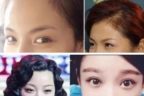 新月型双眼皮6.5毫米案例照片,自然款双眼皮有几种眼型图片