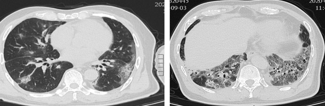 抗合成酶综合征是肺纤维化吗,抗合成酶综合征体征