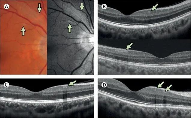 新冠病毒感染者有眼部症状吗,新冠病毒眼部传播