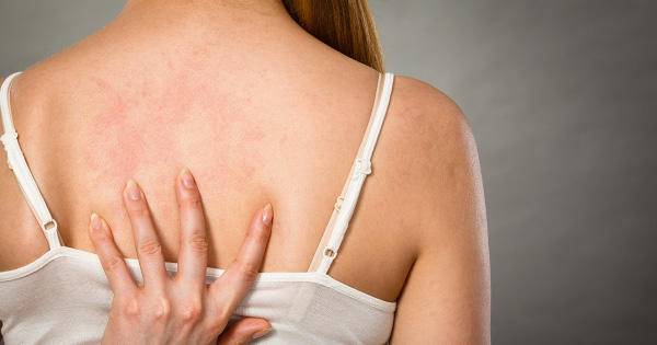 慢性荨麻疹减药规律,荨麻疹治疗都用激素会发胖吗