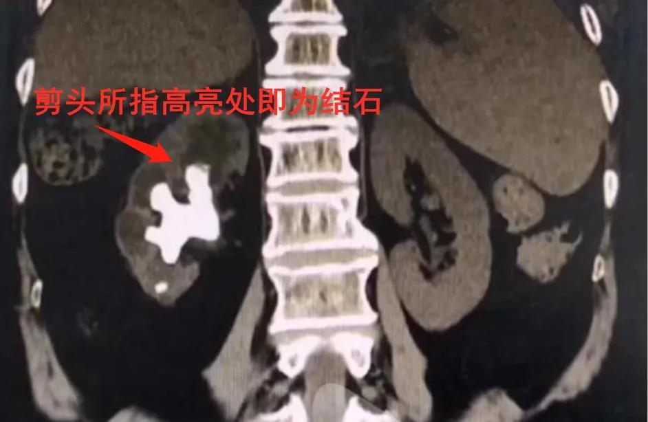 肾内结石过大怎么办,阜新治疗输尿管结石