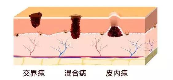 医生如何判断痣切干净了没,医生如何判断痣与黑色素瘤