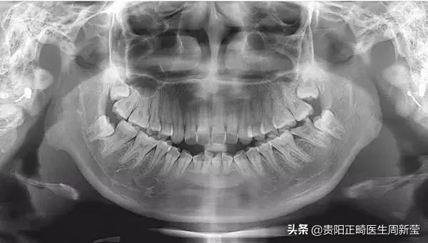 牙齿开瓶盖是嫌它太硬吗?牙齿使用说明书,简直太绝了