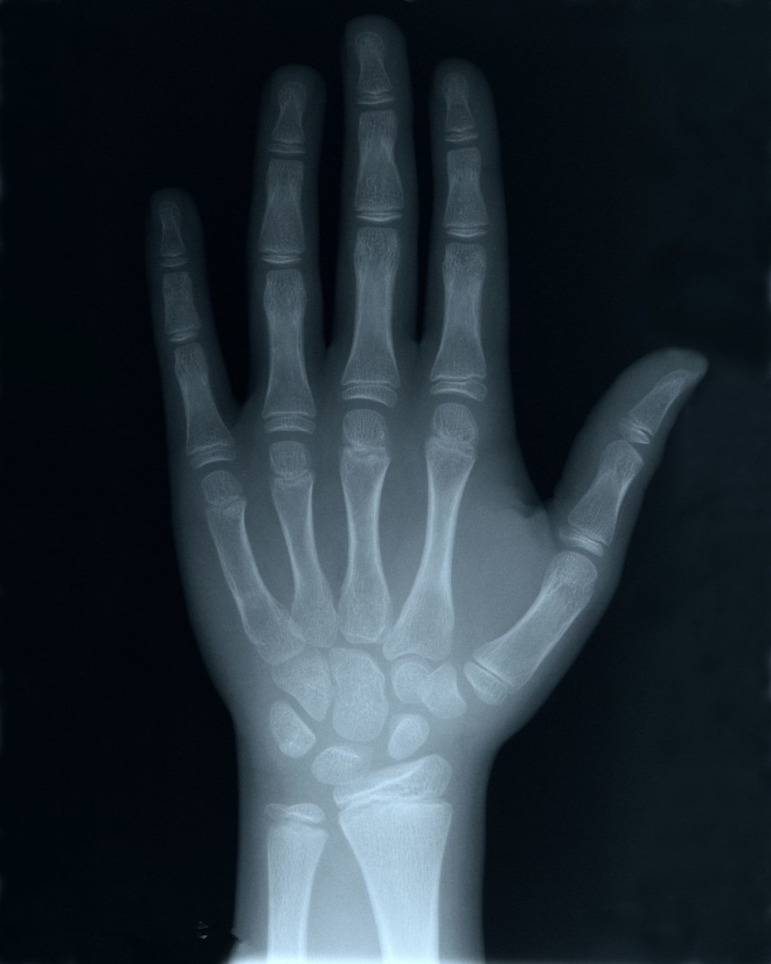 什么是X射线，它是如何被发现的，对人类有多大影响？