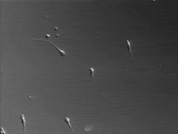 严重弱精症原因,重度少精弱精症可能的原因