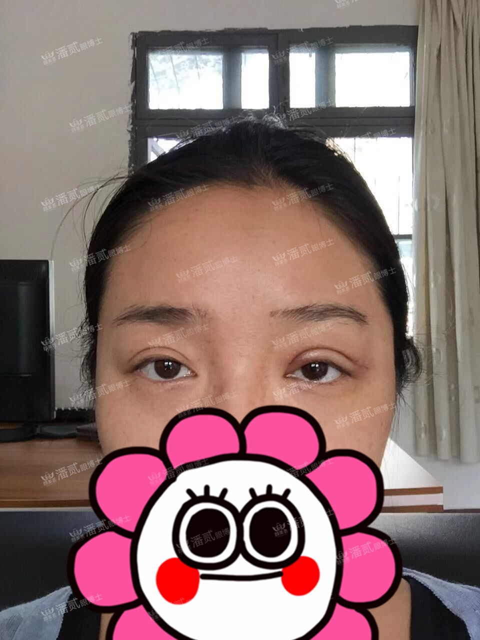 提肌矫正失败的表现眼皮睁不开,做完提肌眼睛前半段下垂