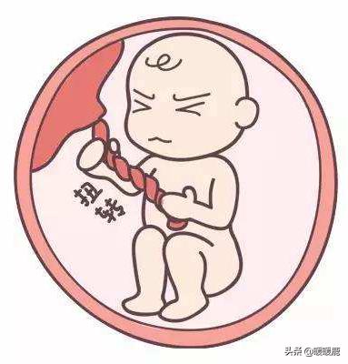 脐带绕颈几周会畸形,脐带扭转和脐带绕颈的区别