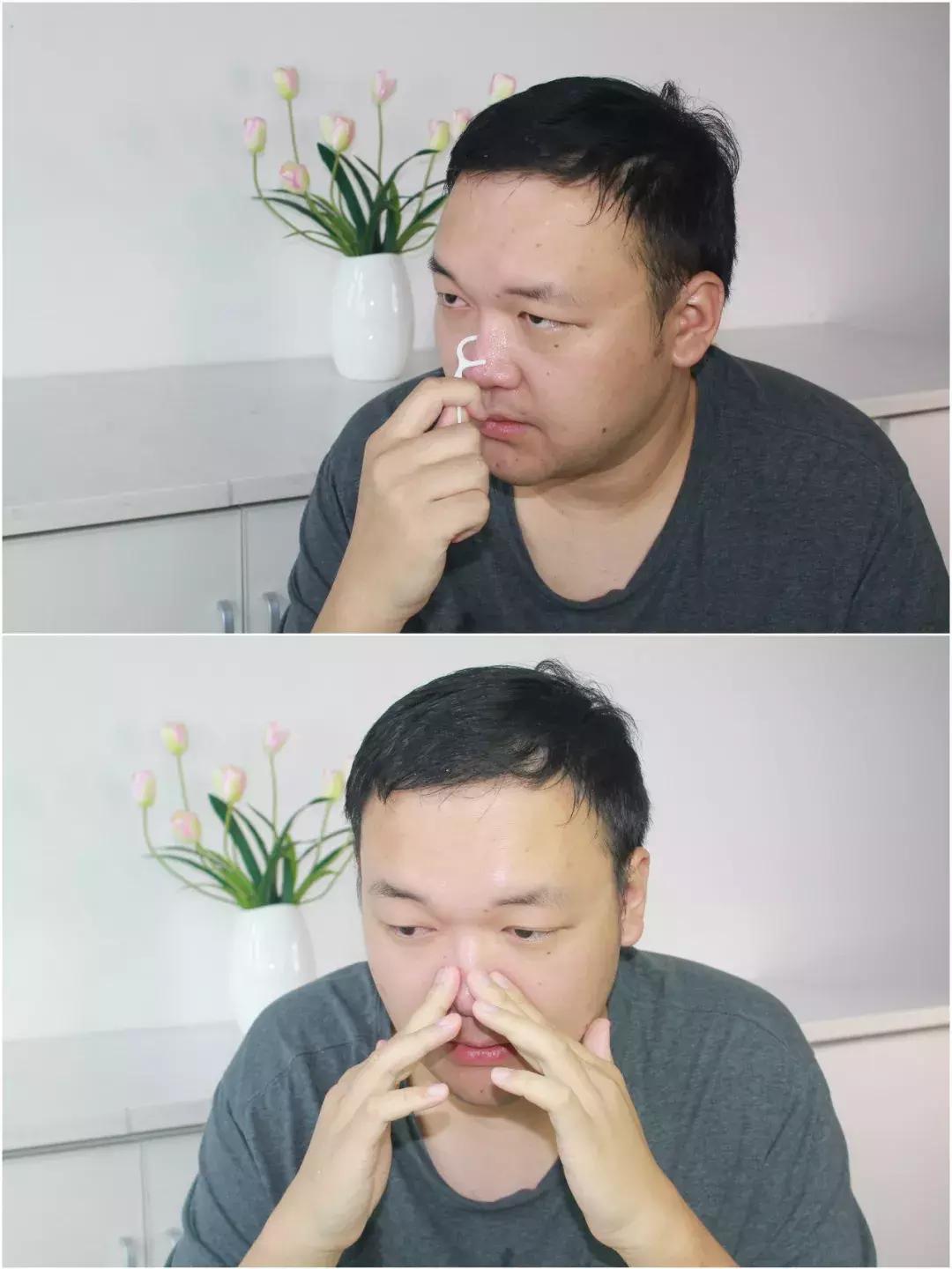 用芦荟胶去除粉刺,芦荟胶真的可以去黑头吗