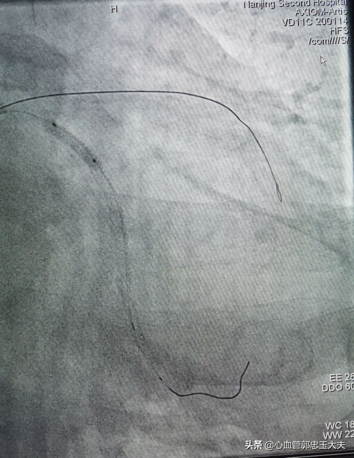 CTO遇到钙化病变怎样才能把血管打通?