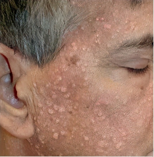 脸上长了闭口小颗粒怎么去除,脸上白色颗粒怎么去除