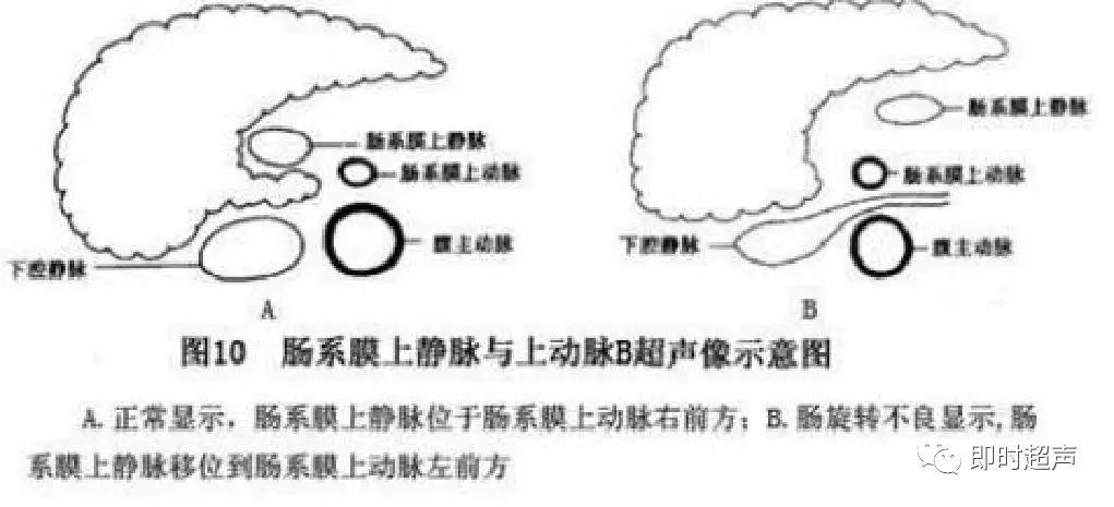 小儿消化道急症超声