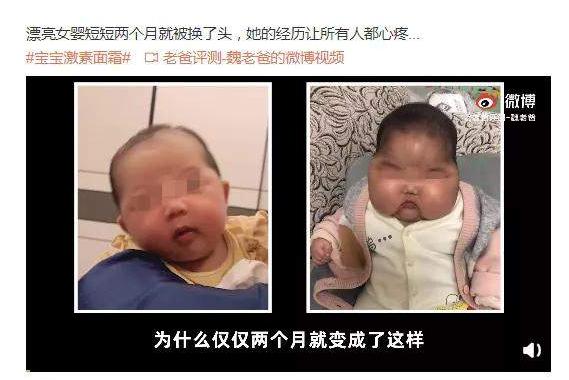 脸部皮炎使用激素药膏可以吗,医用护肤品修复激素依赖性皮炎