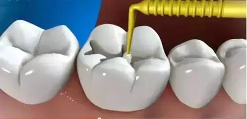 补牙一年后冷水漱口牙痛,补牙之后牙痛是怎么回事