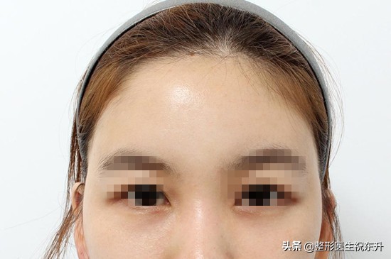 去眼袋做不做眶隔脂肪释放,眶隔脂肪释放和内切去眼袋过程