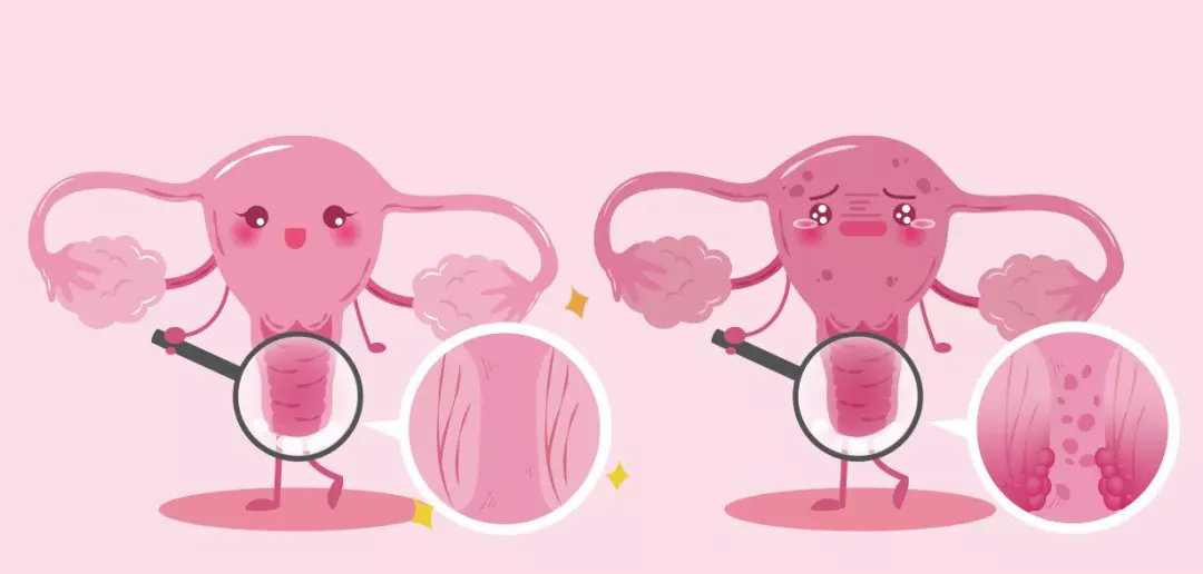 更年期女性要做hpv和tct检查吗,女性做hpv和tct检查前注意事项