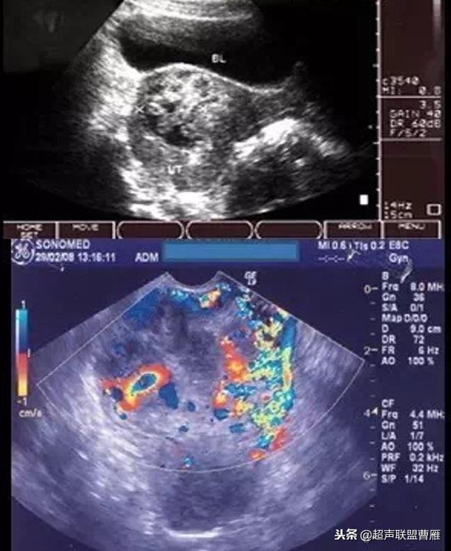 剖宫产疤痕妊娠动画,剖宫产疤痕妊娠的临床分型