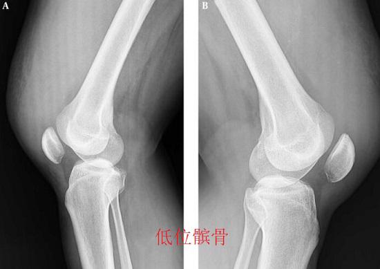膝关节退化保守治疗,膝关节手术治疗和保守治疗