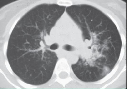 结节病关节痛眼睛模糊,结节病引起的关节炎