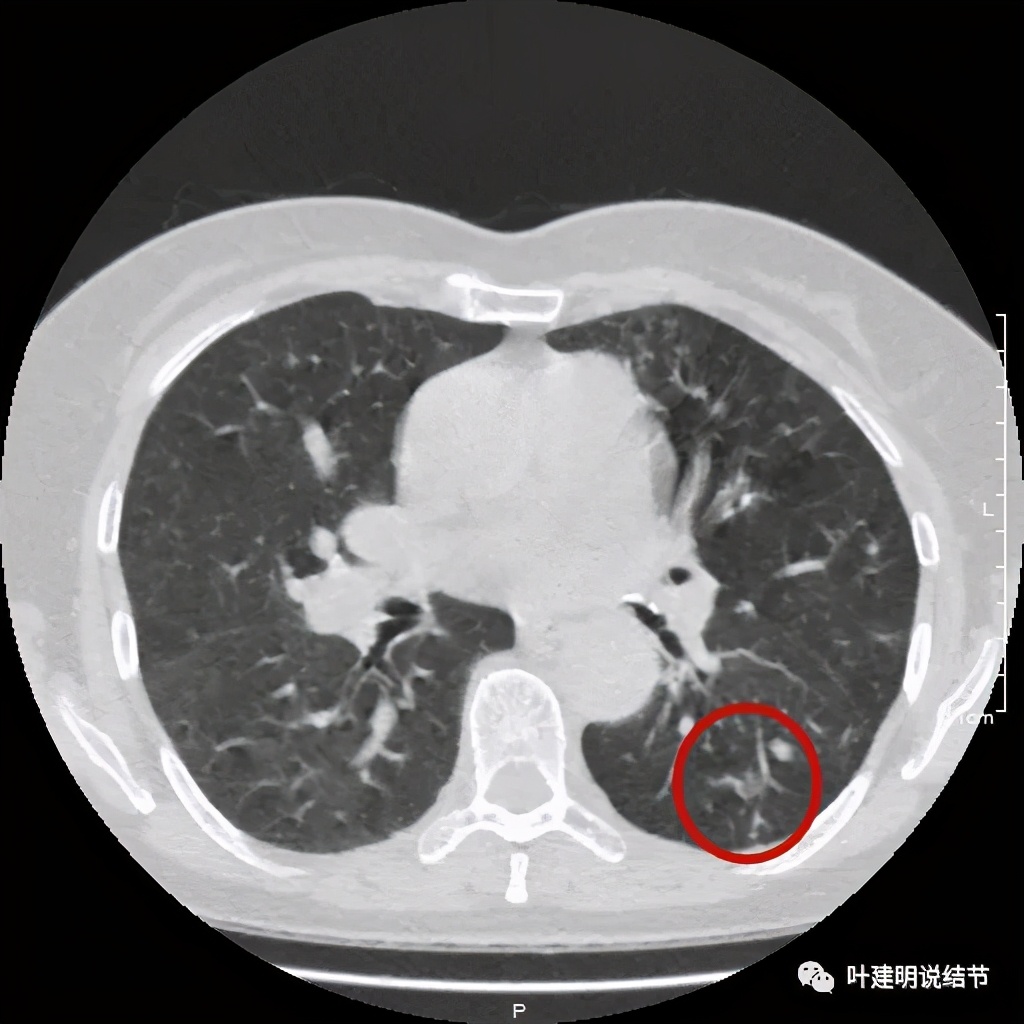 这样的实性结节伴小空洞会是肺癌吗？