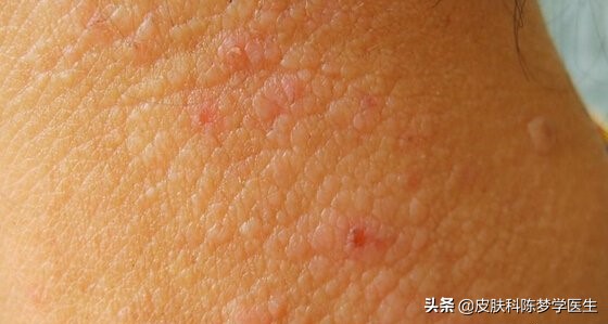 牛皮癣是不死之痘,牛皮癣和肝癌症有关系吗