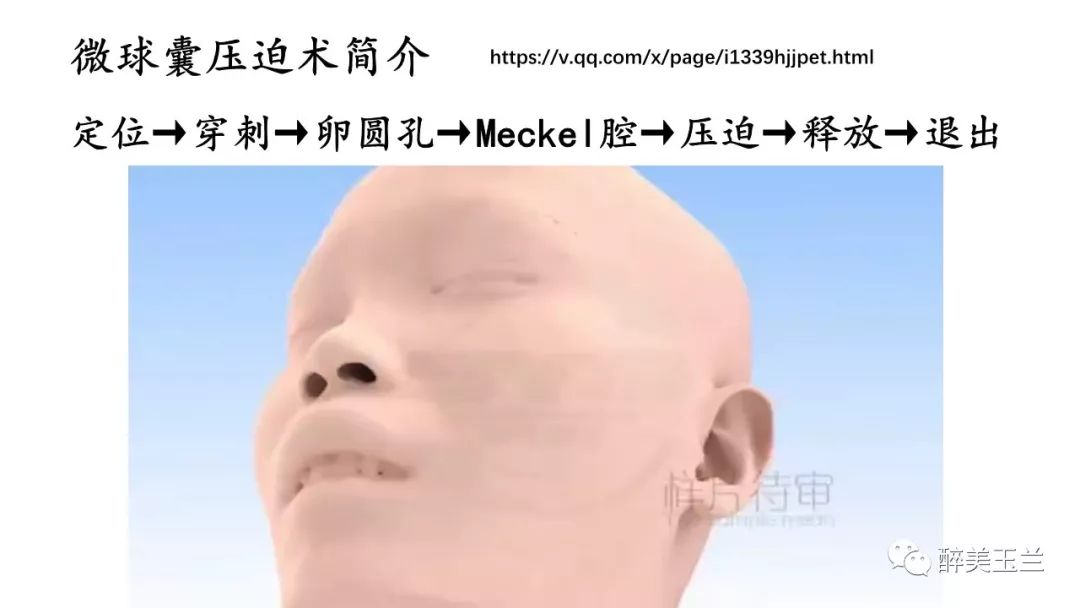 病例分享丨三叉神经节微球囊压迫术的麻醉管理