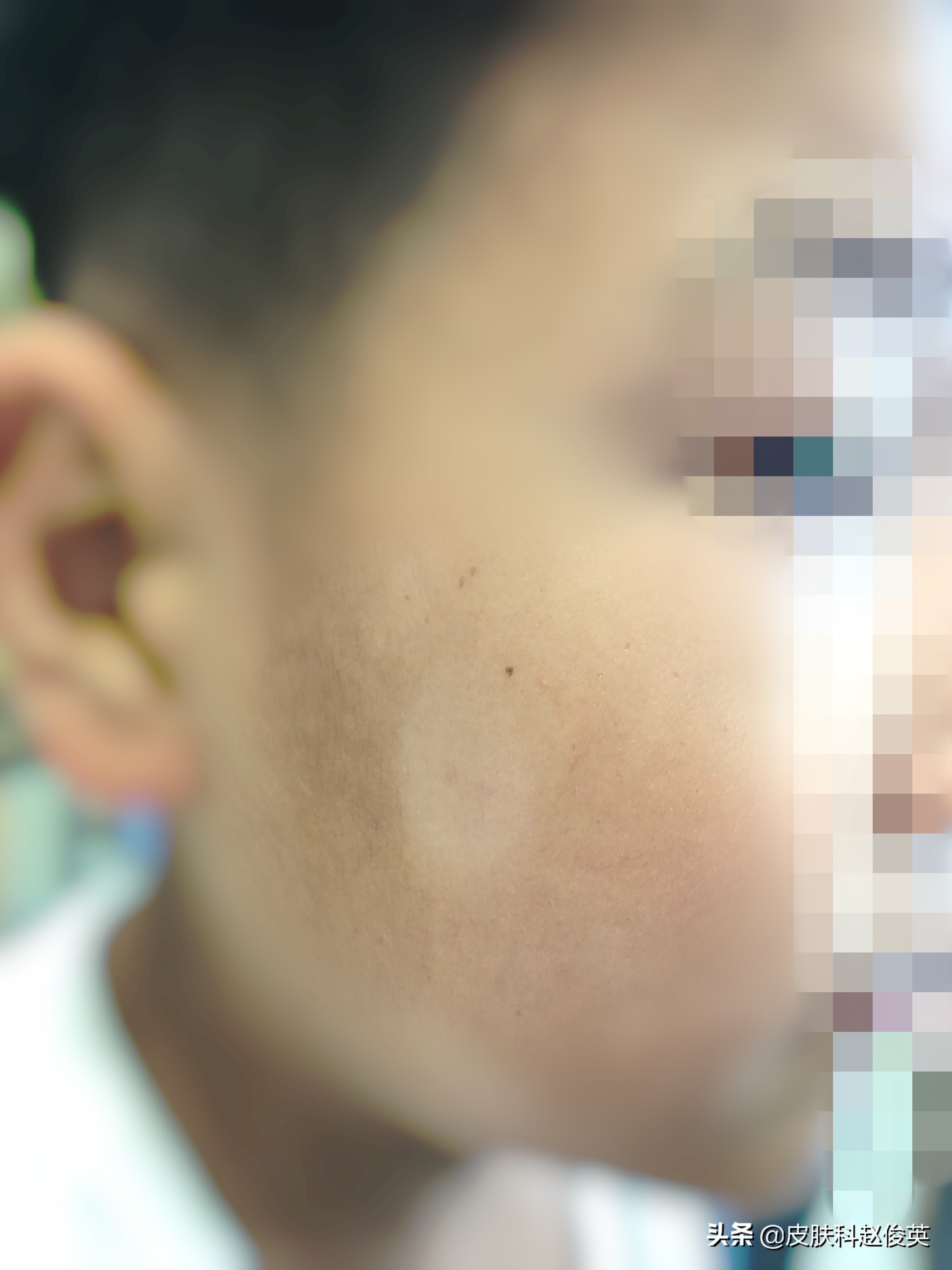 脸上有白色斑块怎么回事吃什么药,医生脸上有斑点