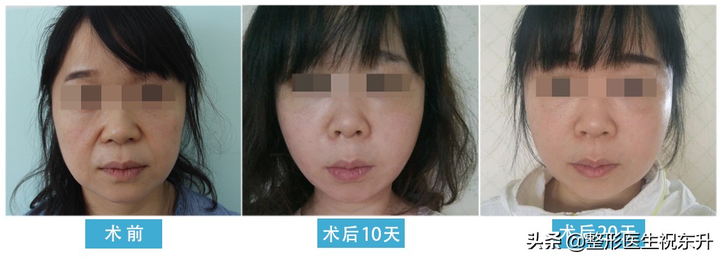 做完拉皮手术感觉效果不明显,拉皮手术后头部针刺样疼怎么回事