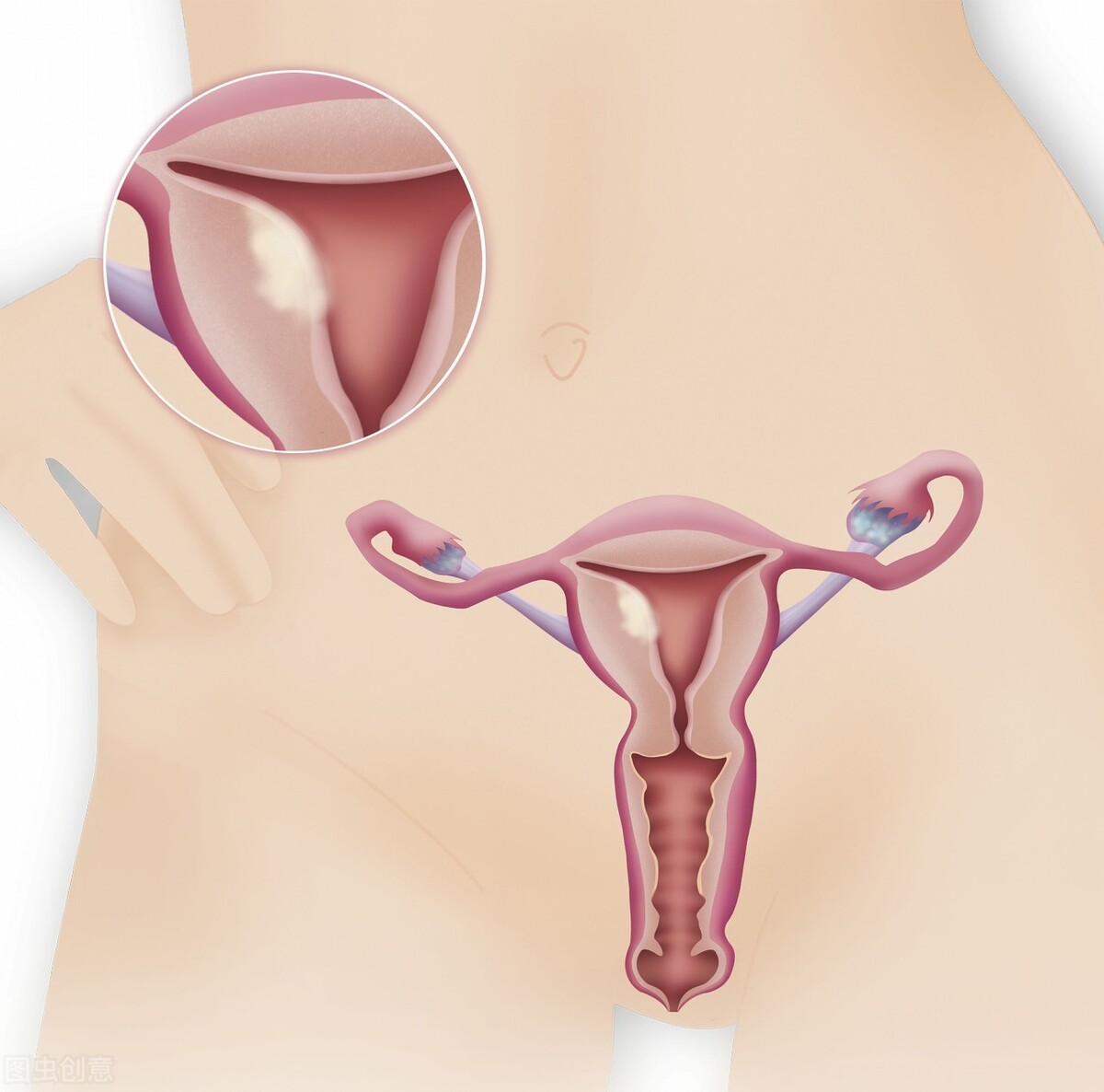 子宫摘除对夫妻生活会有影响吗？医生：有，但影响不大