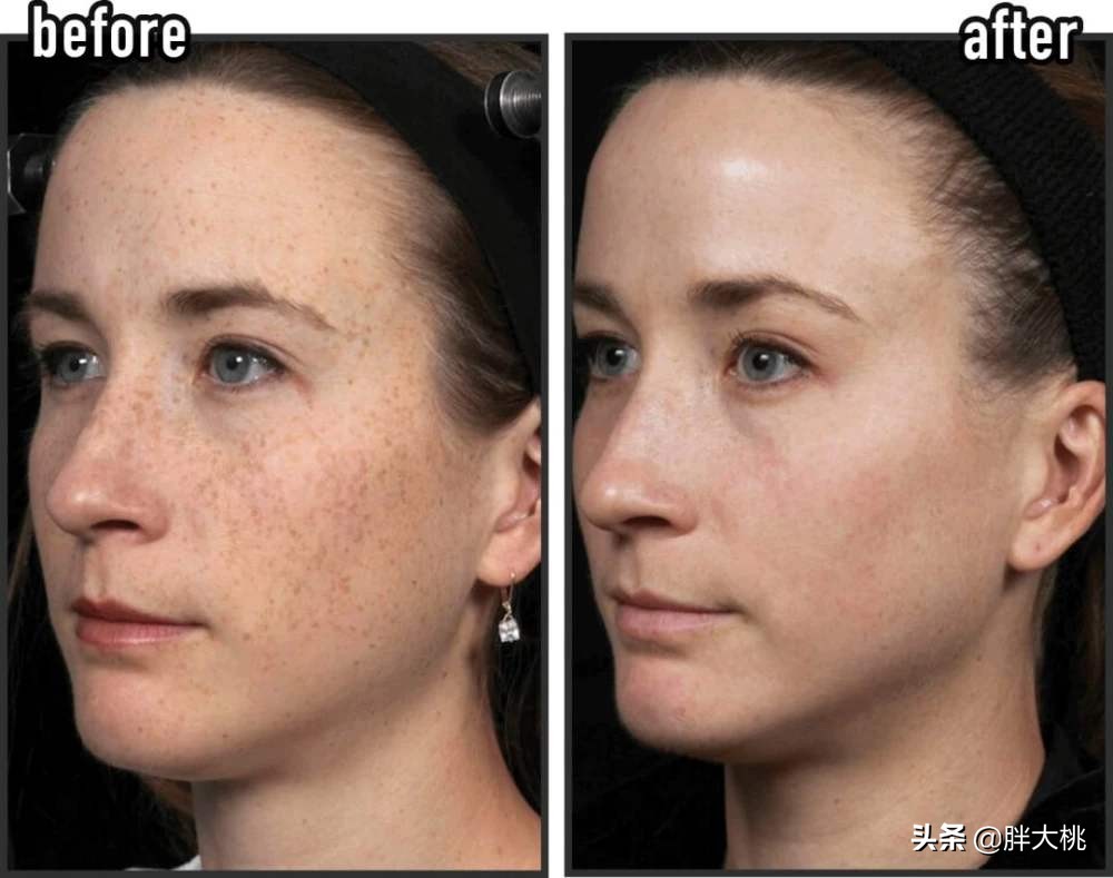 黑头闭口刷水杨酸好还是果酸好,毛孔黑头闭口怎么刷酸