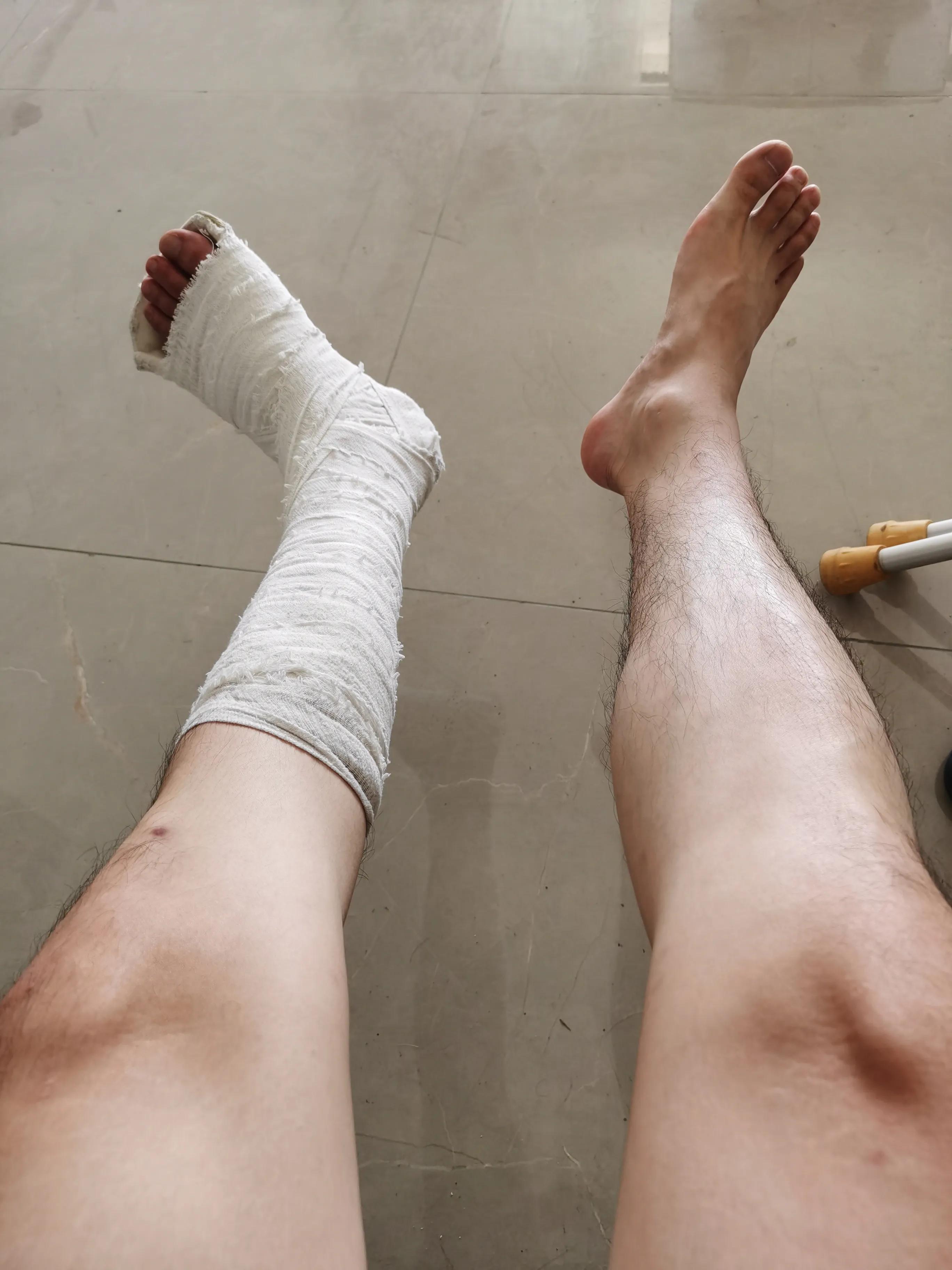 第五跖骨基底部骨折60天能走路吗,第五跖骨基底部骨折60天能脱拐吗