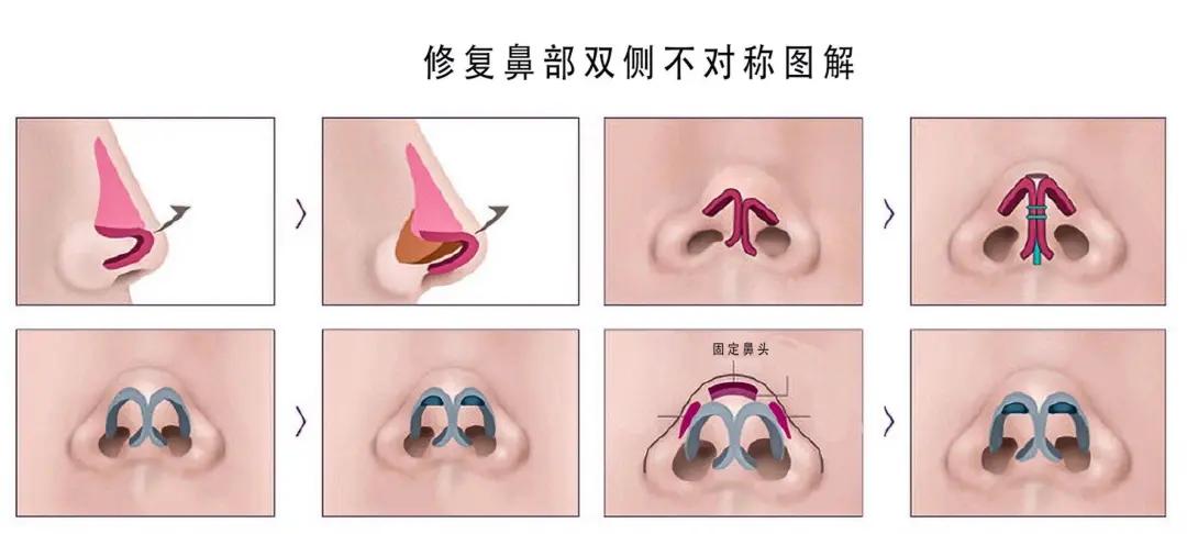 鼻孔不对称最佳解决方法,鼻子一侧通气不流畅鼻孔不对称