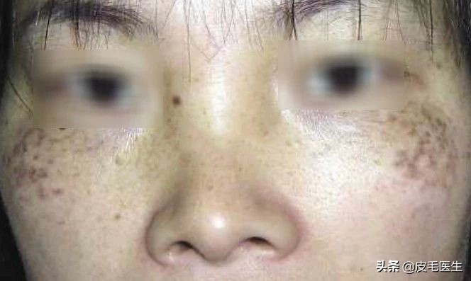 雀斑黄褐斑老年斑祛斑方法,褐斑老年斑怎么治疗效果最好